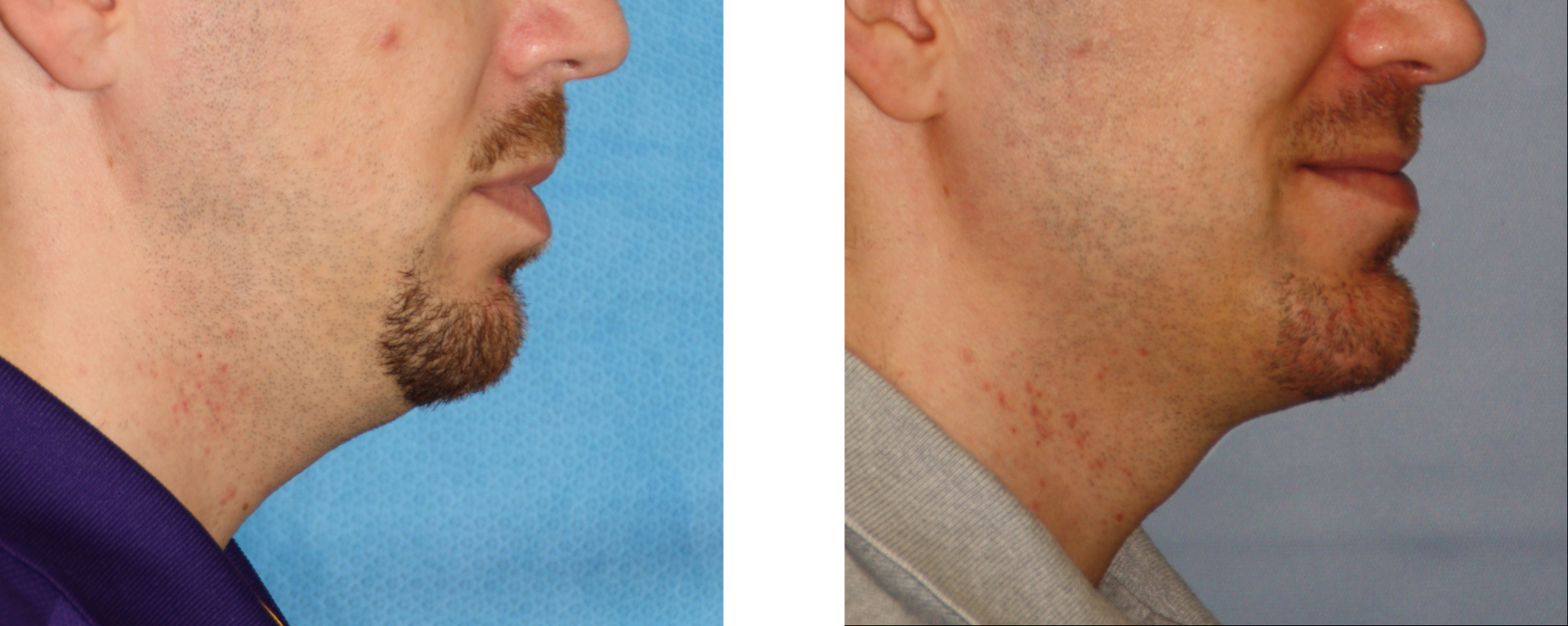 Side-by-side comparison of a man's face before and after a chin augmentation procedure.