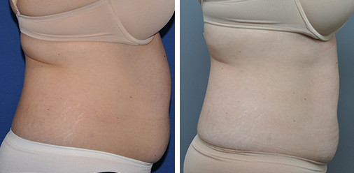 Comparison of a woman's abdomen before and after a surgical procedure. The 