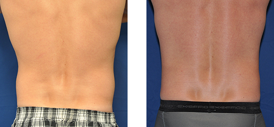 Before and after photos of a person's back; the 