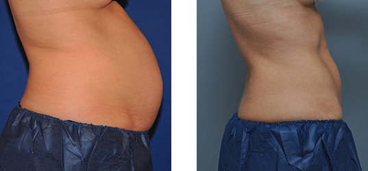 Before-and-after of a person's abdomen, showing a reduction in abdominal bulge. Skin is brown.