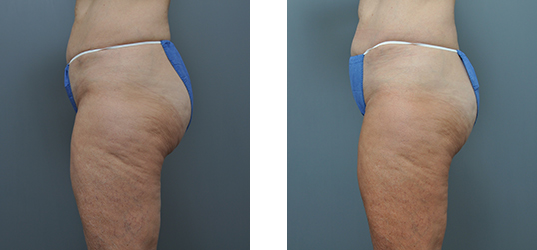 Before and after images of a person's thighs and buttocks; cellulite reduction after treatment.