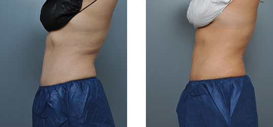 Side-by-side view of a person's torso before and after a procedure. The after photo shows a more contoured abdomen.