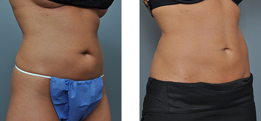Before and after photos showing coolsculpting results