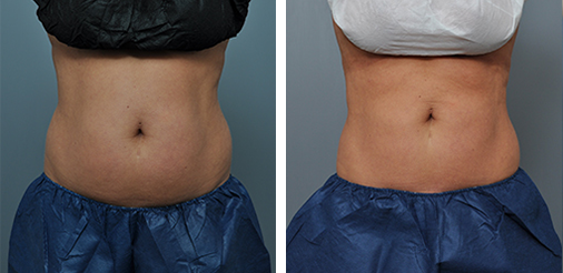 Before and after abdominal image; right side: slimmer abdomen, left side: fuller abdomen.