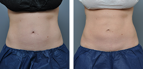 Side-by-side comparison of a person's abdomen before and after a procedure, showing a reduction in fat.