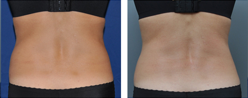 Two views of a person's lower back, before and after a treatment.