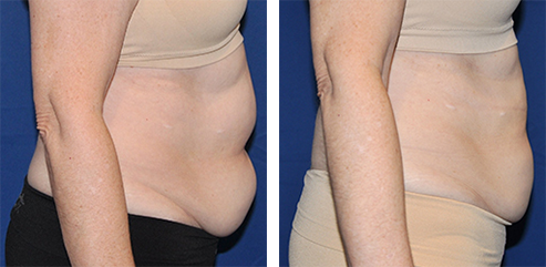 Side-by-side view of a person's abdomen before and after a procedure. The after photo shows a tighter stomach.
