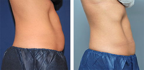 Side-by-side comparison of a person's abdomen, before and after treatment, showing a reduction in fat.