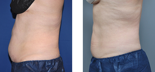 Before and after abdominal view. The after picture shows a reduction in waist size.
