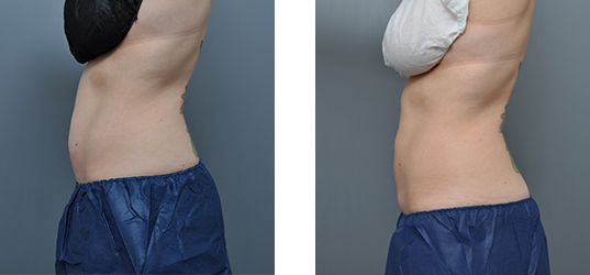 Side-by-side view of a person's torso before and after a procedure, showing body contouring changes.