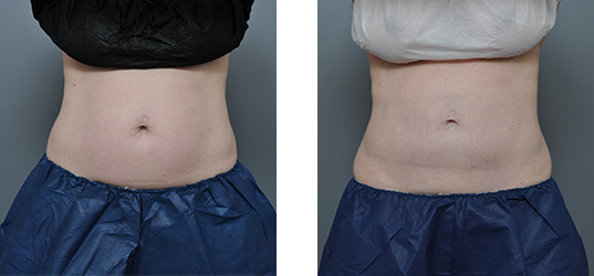 Side-by-side comparison of a person's abdomen before and after a procedure.