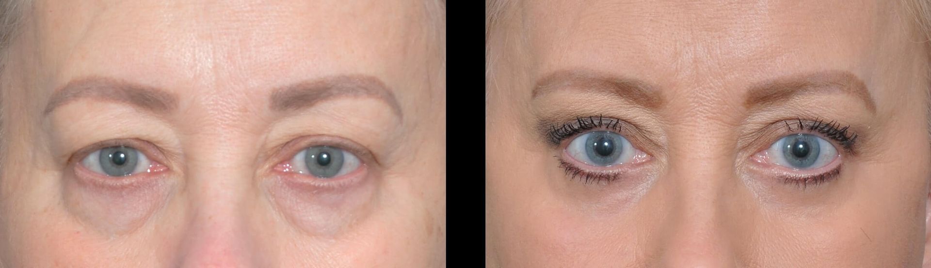 Before and after photos showing eyelids appearing less droopy.