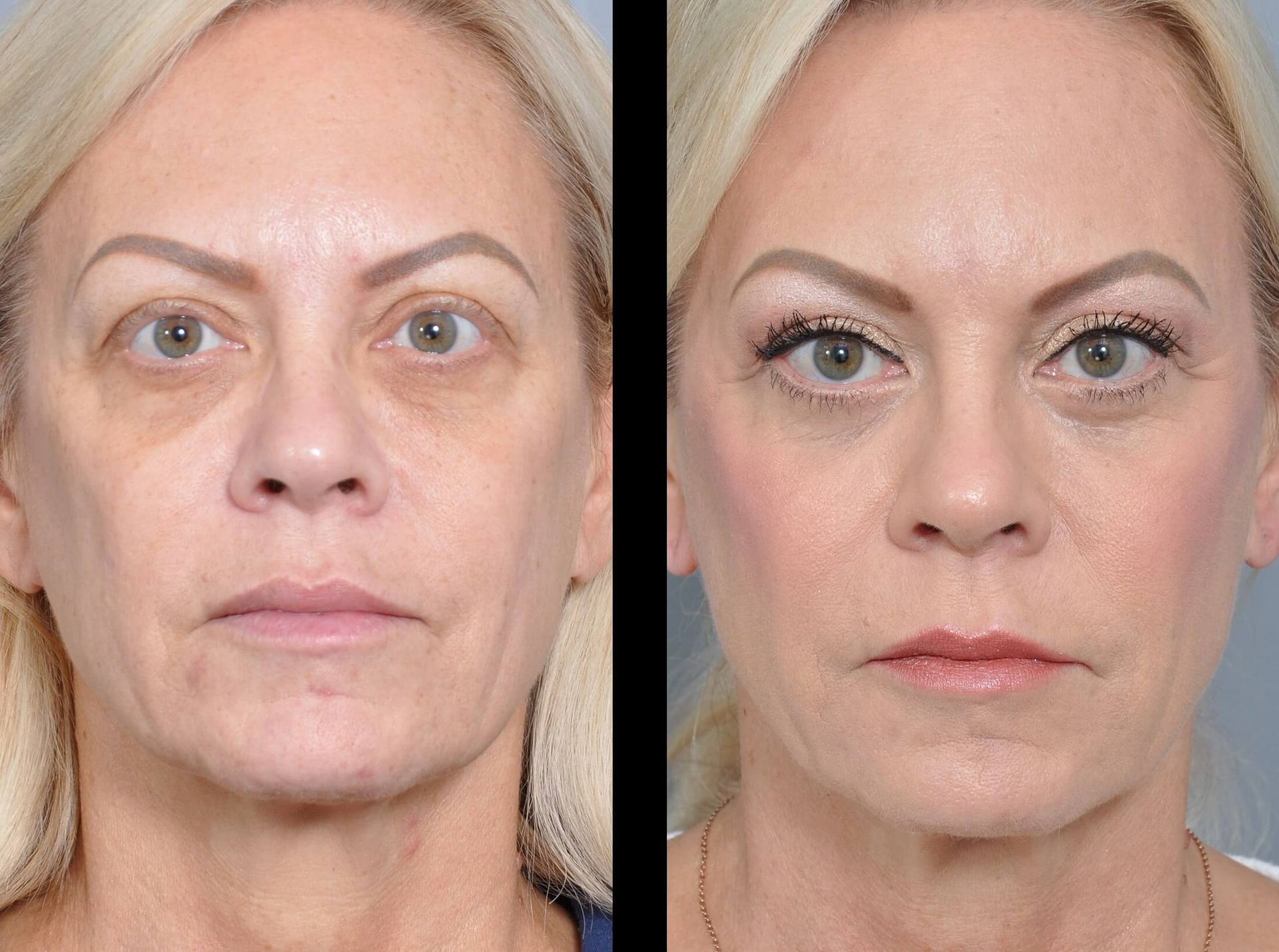 Before and after photos of a person's face. After shows tighter skin, with subtle makeup.