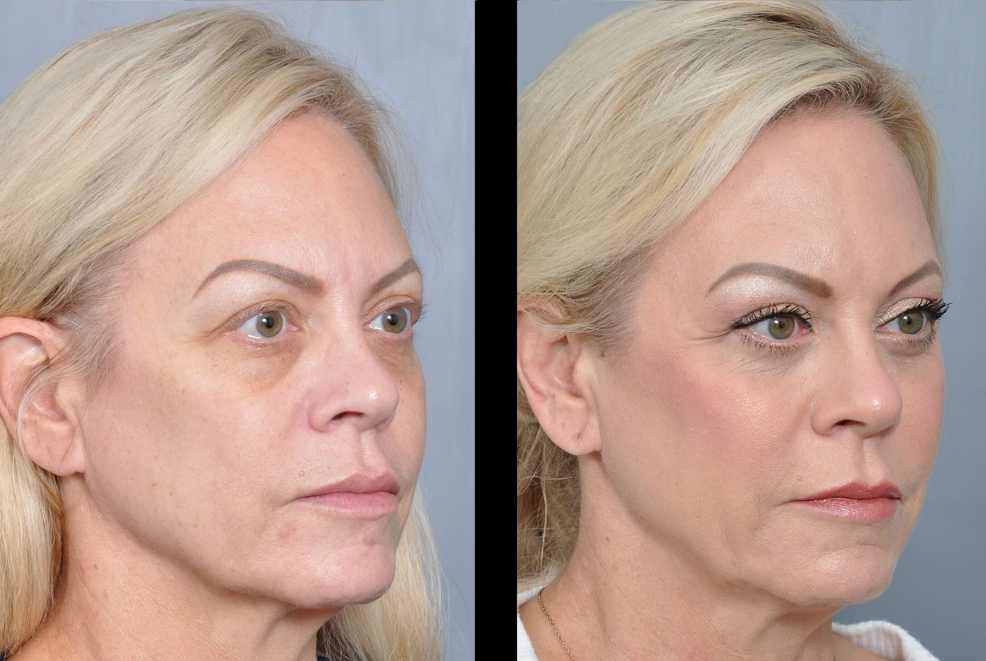 Woman's face before and after cosmetic surgery, showing reduced wrinkles and improved skin tone.