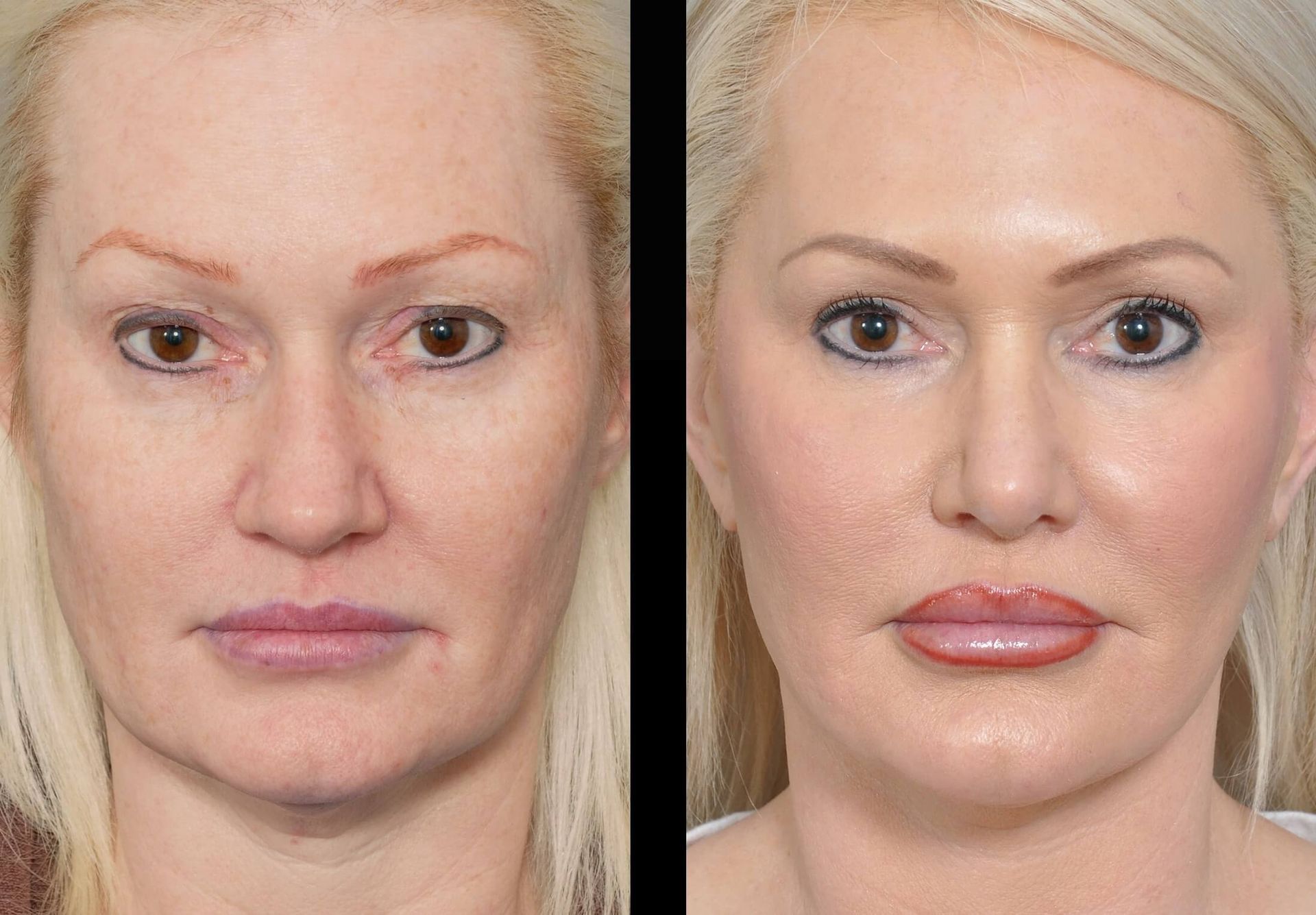 Side-by-side comparison of a person's face before and after cosmetic procedures, showing changed lips, cheeks, and eyes.
