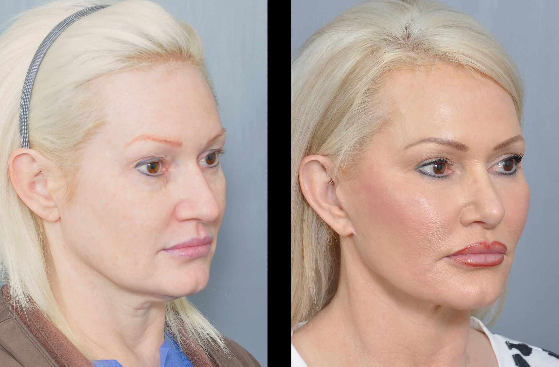 Before and after photos of a woman's face, showing cosmetic surgery results.