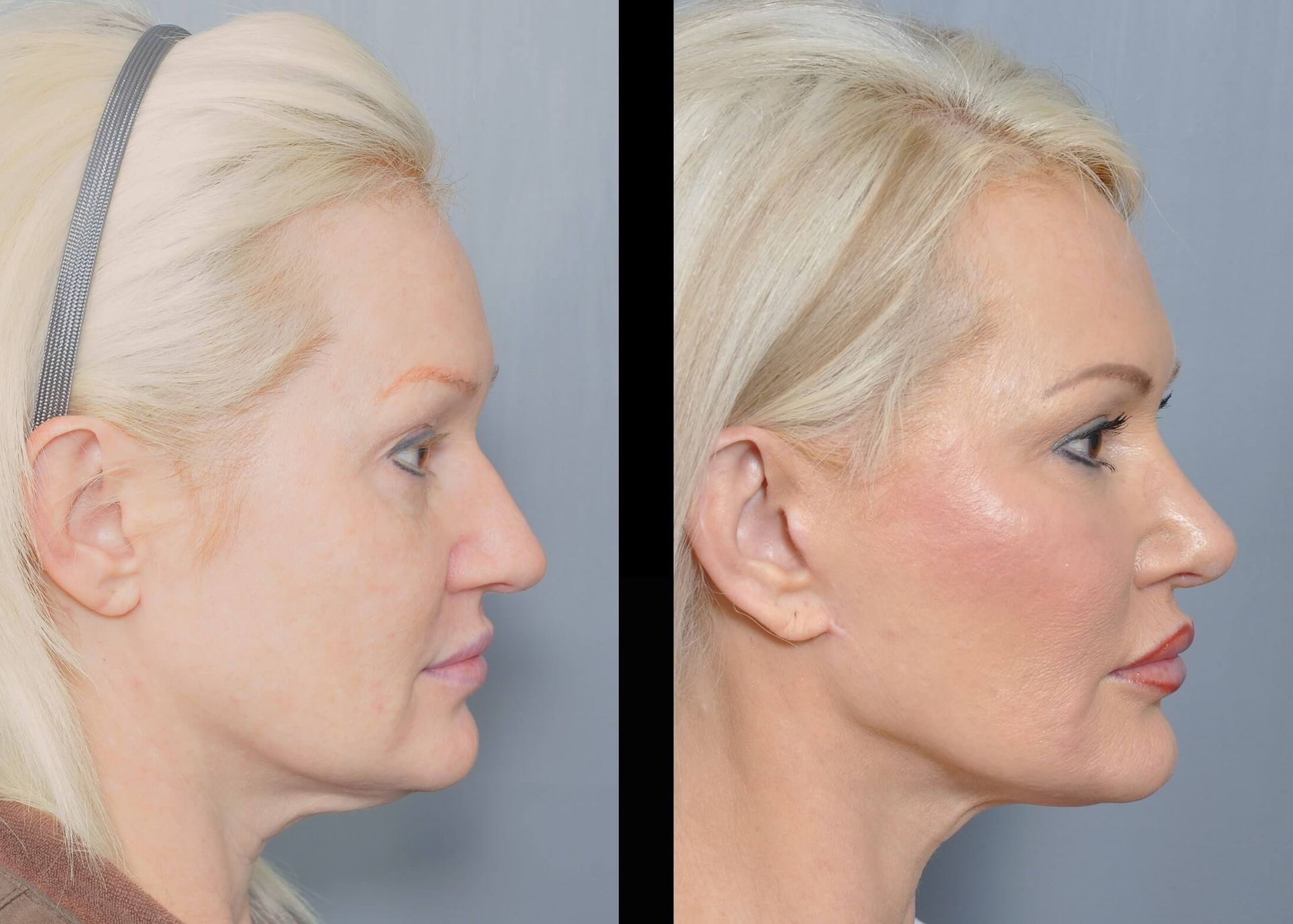 Before and after facial profile photos. Improved jawline, reduced neck fat, and a smoother face.