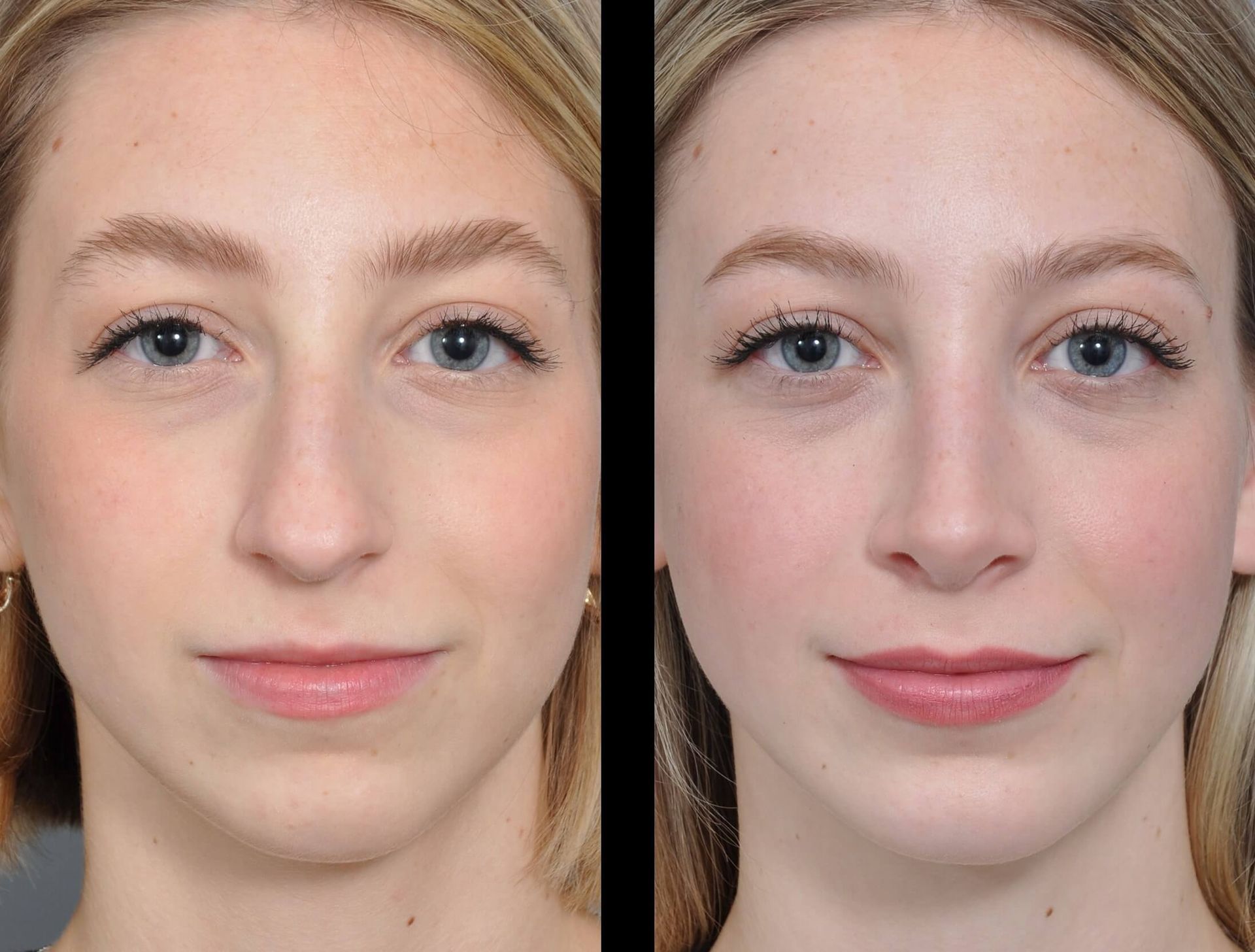 Before and after photos of a person's face; cosmetic enhancements. Blushed cheeks, fuller lips, and refined nose.