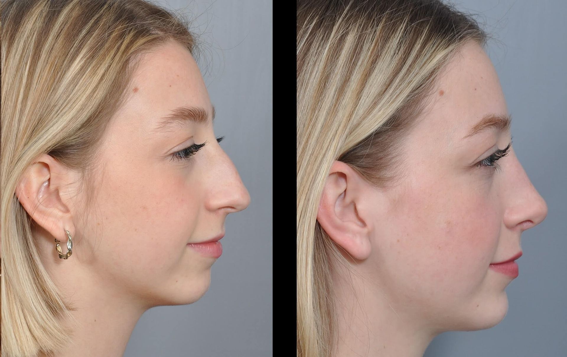 Profile view, before-and-after rhinoplasty. Woman's nose reshaped, reducing a dorsal hump.