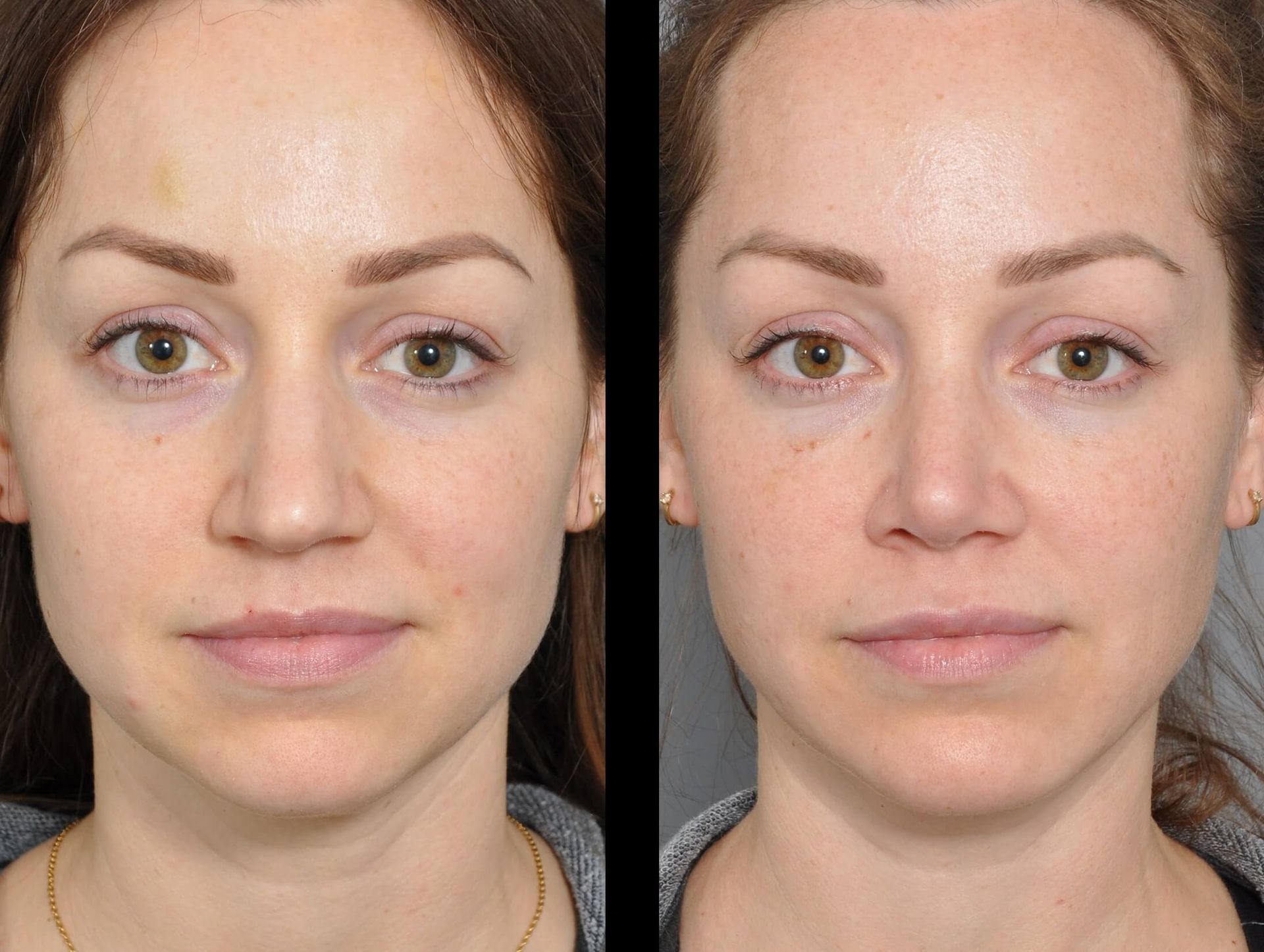 Williamson Cosmetic Center - chin implant gallery