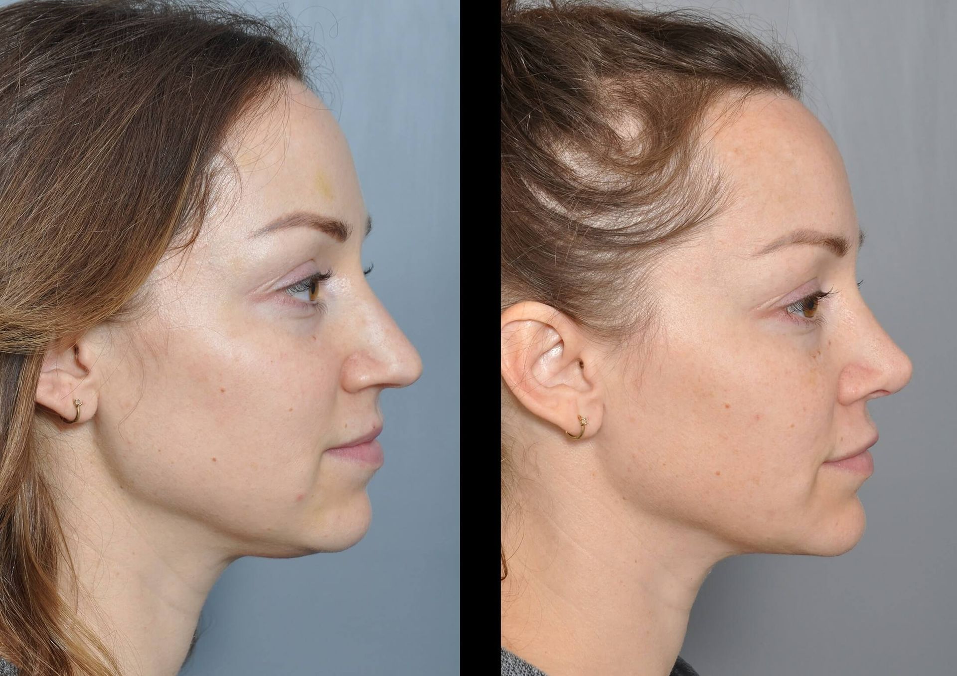 Side-by-side photos of a woman's profile before and after facial cosmetic surgery.