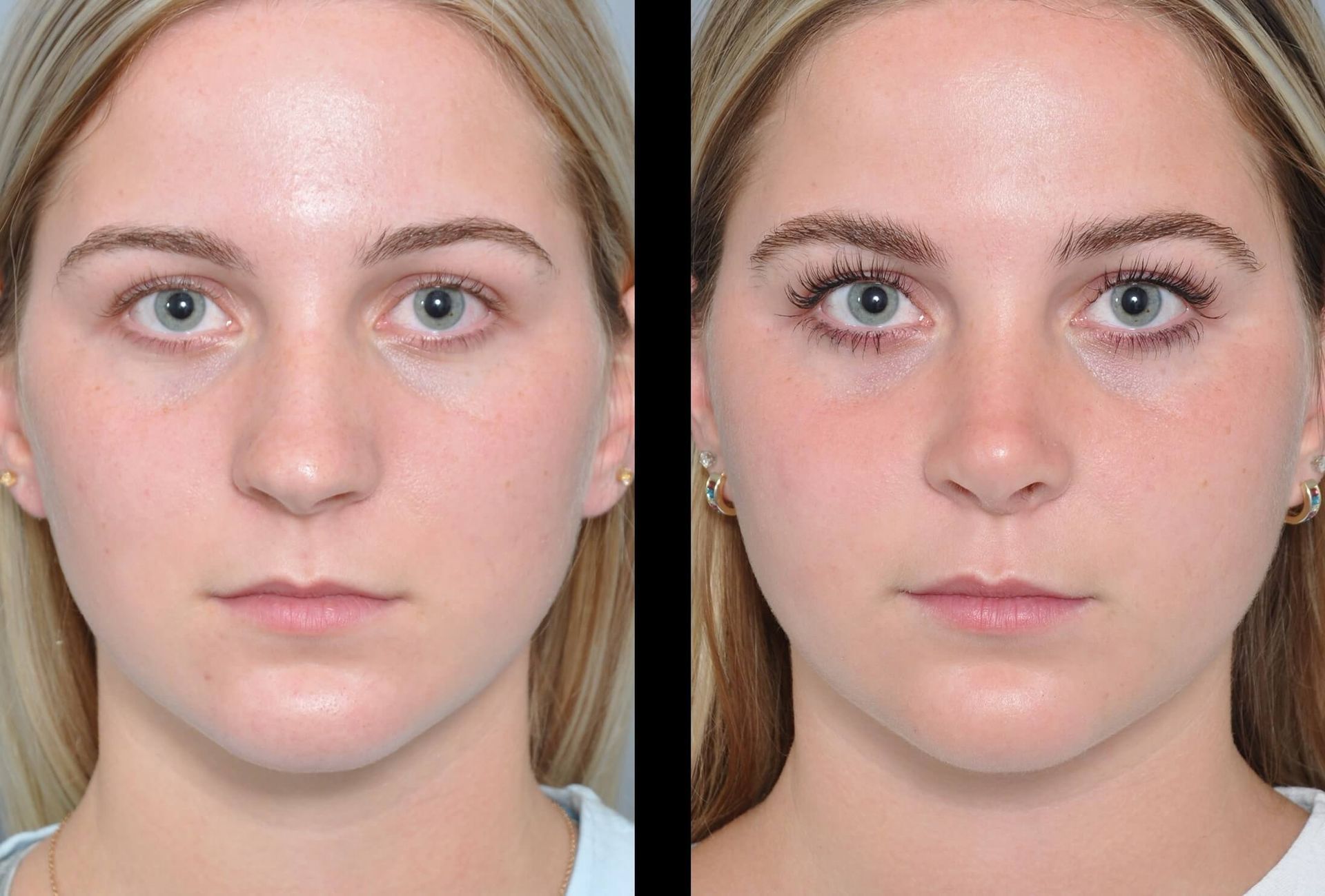 Two side-by-side facial views of a woman; the left shows her before, and the right after cosmetic work on her eyes and face.