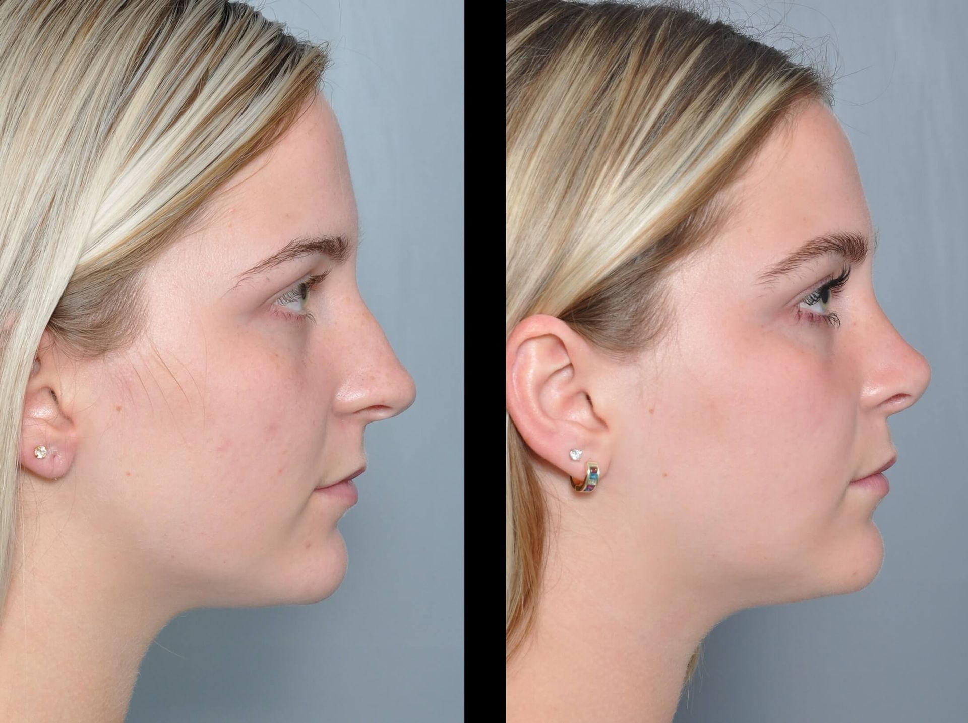 Side-by-side profile views of a person before and after a rhinoplasty, showing a changed nose shape.