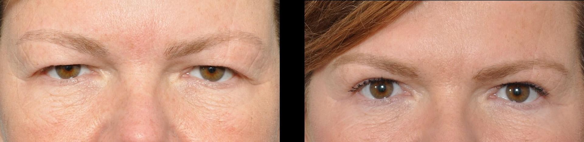 Before and after photos of eyes, showing a cosmetic procedure.
