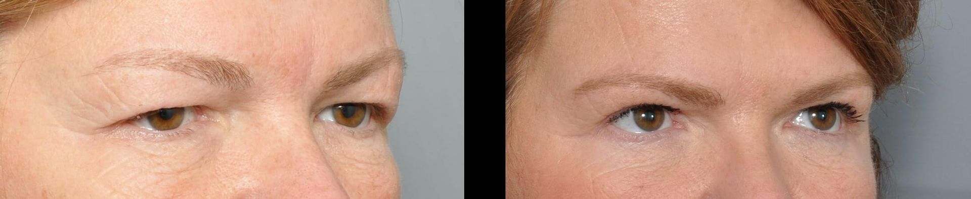 Before and after photos of eyes, showing a blepharoplasty procedure with improved eyelid appearance.