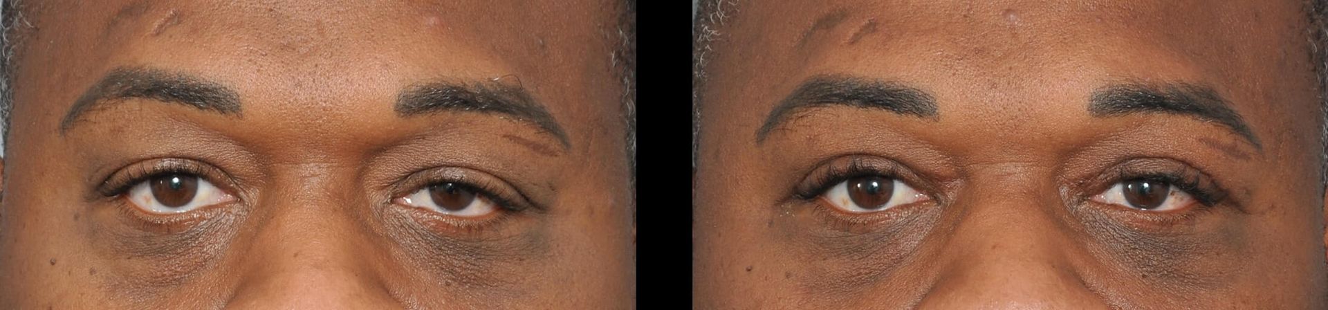 Comparison of two sets of eyes; slight variations in shadows, presumably representing before and after an eye treatment.