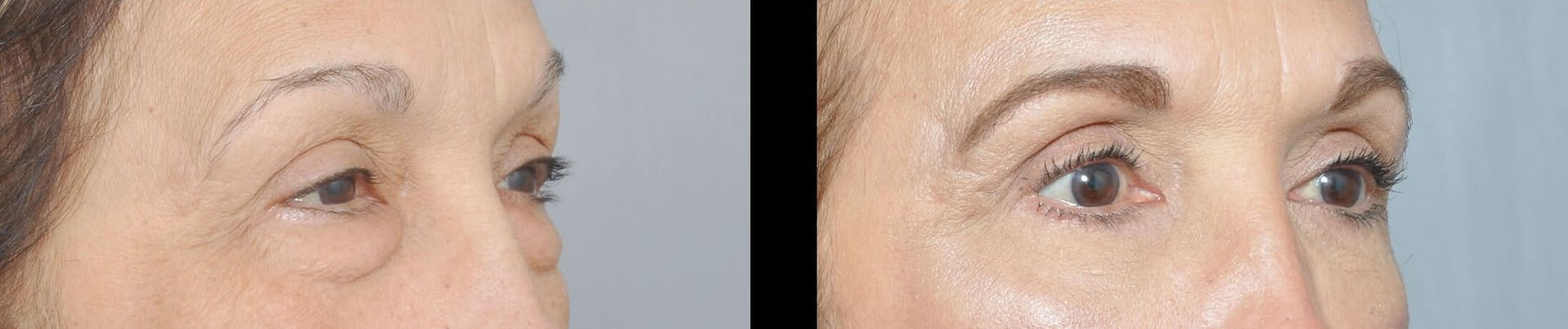 Before and after of a person's eyes, showing a brow lift.