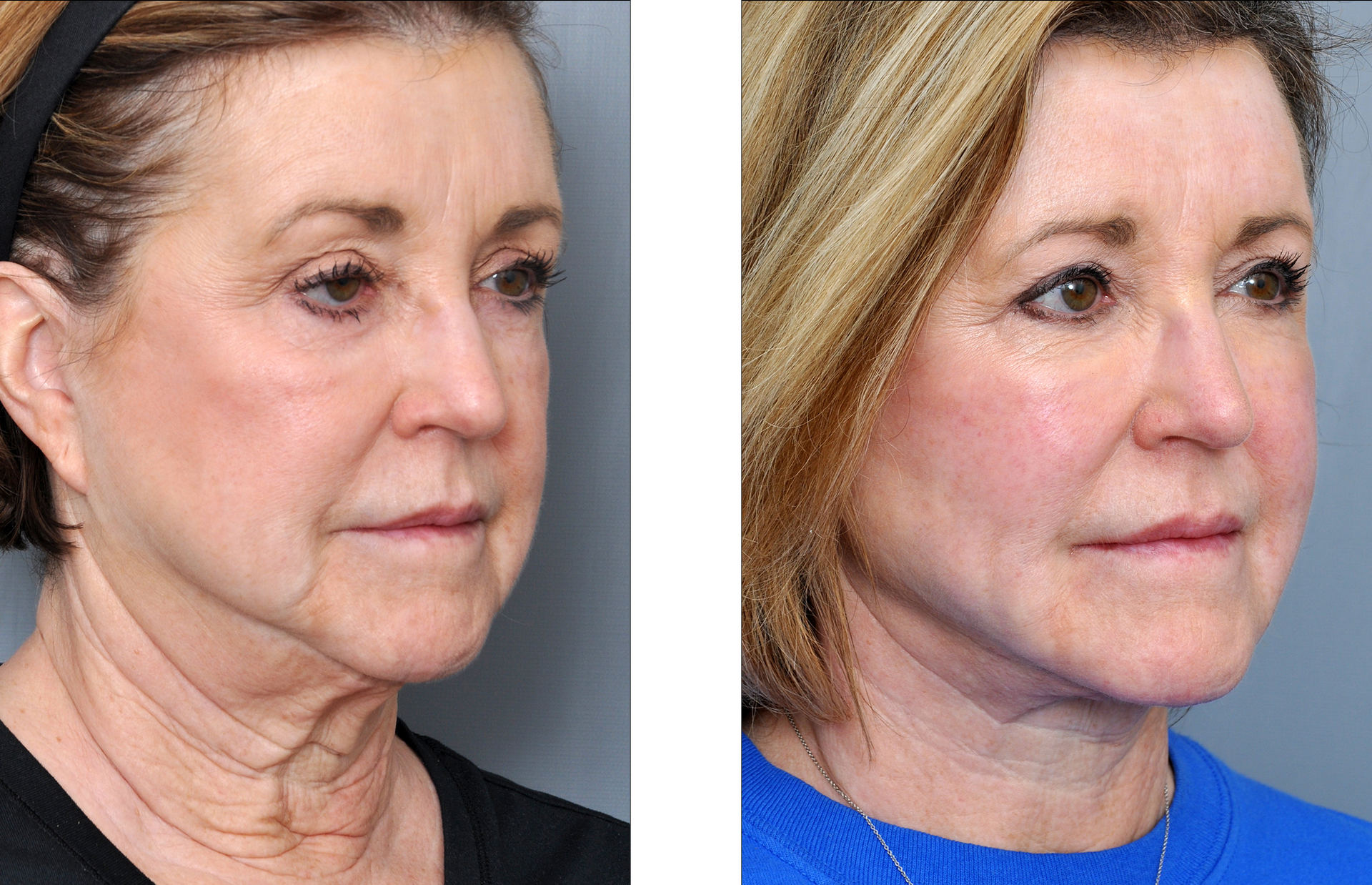 Dr. Jon Perenack - Williamson Cosmetic Center & Perenack Aesthetic Surgery