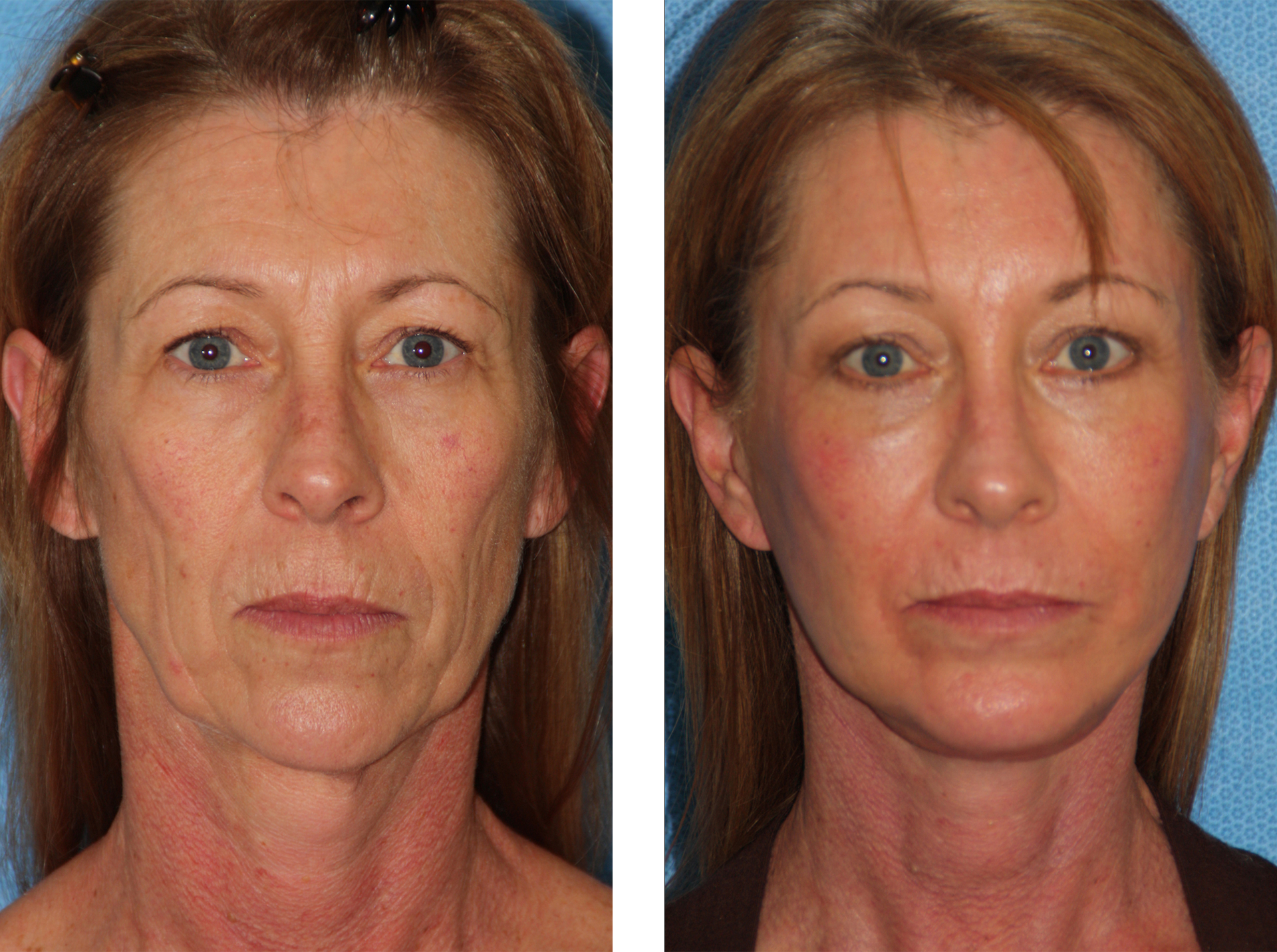 Before and after photos of a person's face after a cosmetic procedure; noticeable reduction in wrinkles.
