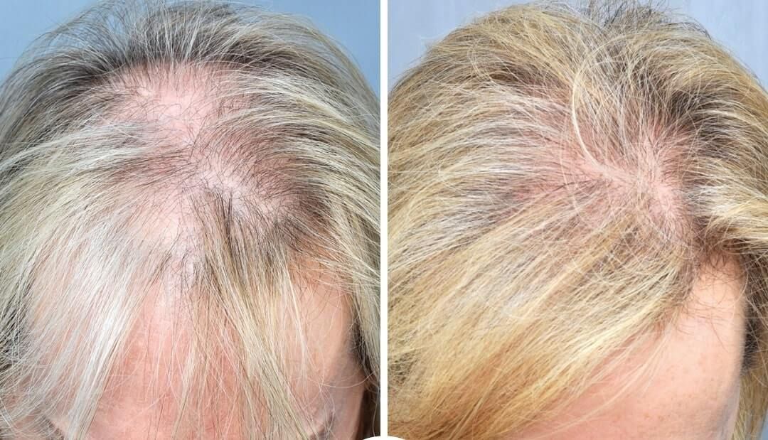 Before and after photos of a person's scalp, showing hair growth following a treatment.