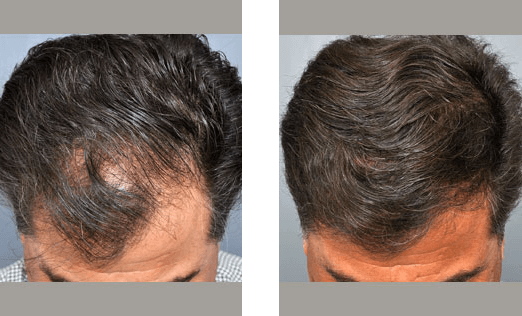 Before and after view of a man's scalp, showing hair loss then increased hair growth.
