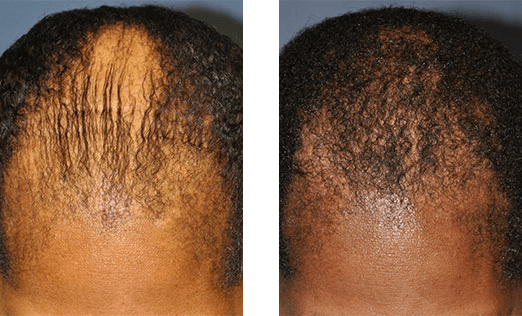 Two views of a scalp. The left side shows thinning hair. The right shows denser hair coverage.