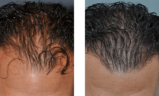 Before and after images of a receding hairline, showing hair growth following a procedure.