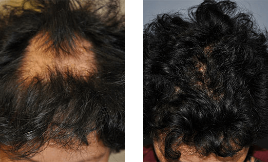 Williamson Cosmetic Center - hair restoration gallery