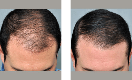 Hair loss progression before and after treatment, frontal view of a man's head, showing significant hair growth.