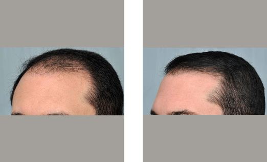Before and after views of a person's hairline after hair transplant.