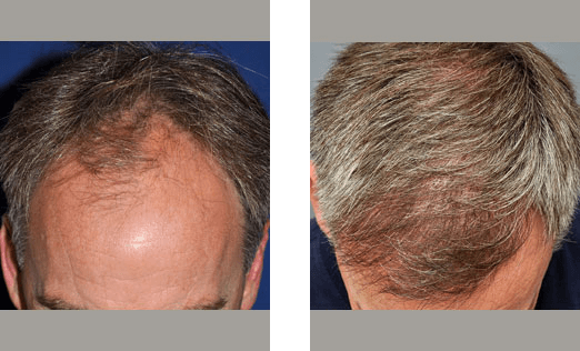 Before and after photos showing hair growth on a man's scalp. Baldness visible in the 