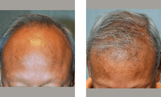 Before and after photos of a receding hairline, showing increased hair growth after treatment.