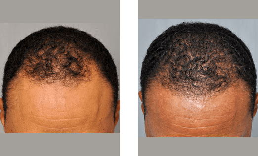 Before and after of a person's scalp, showing hair loss improvement after treatment.