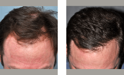 Before and after comparison of a person's head, showing hair restoration.