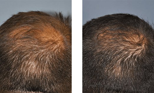 Comparison of a person's scalp: before and after hair growth treatment, showing increased hair density.