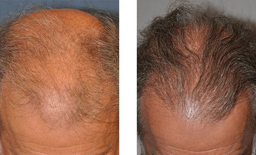 Before and after view of a balding scalp with increased hair growth.
