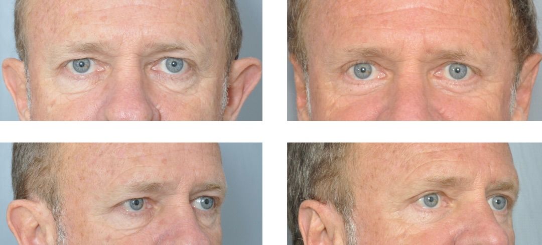 Four-panel comparison of a person's ears, eyes, and brow before and after cosmetic surgery.