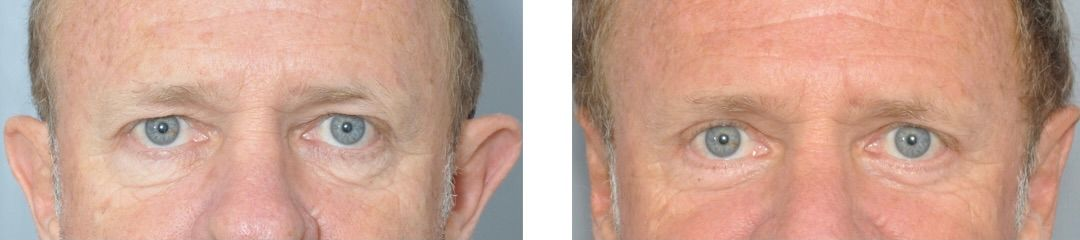 Four images of a man's face before and after ear surgery.