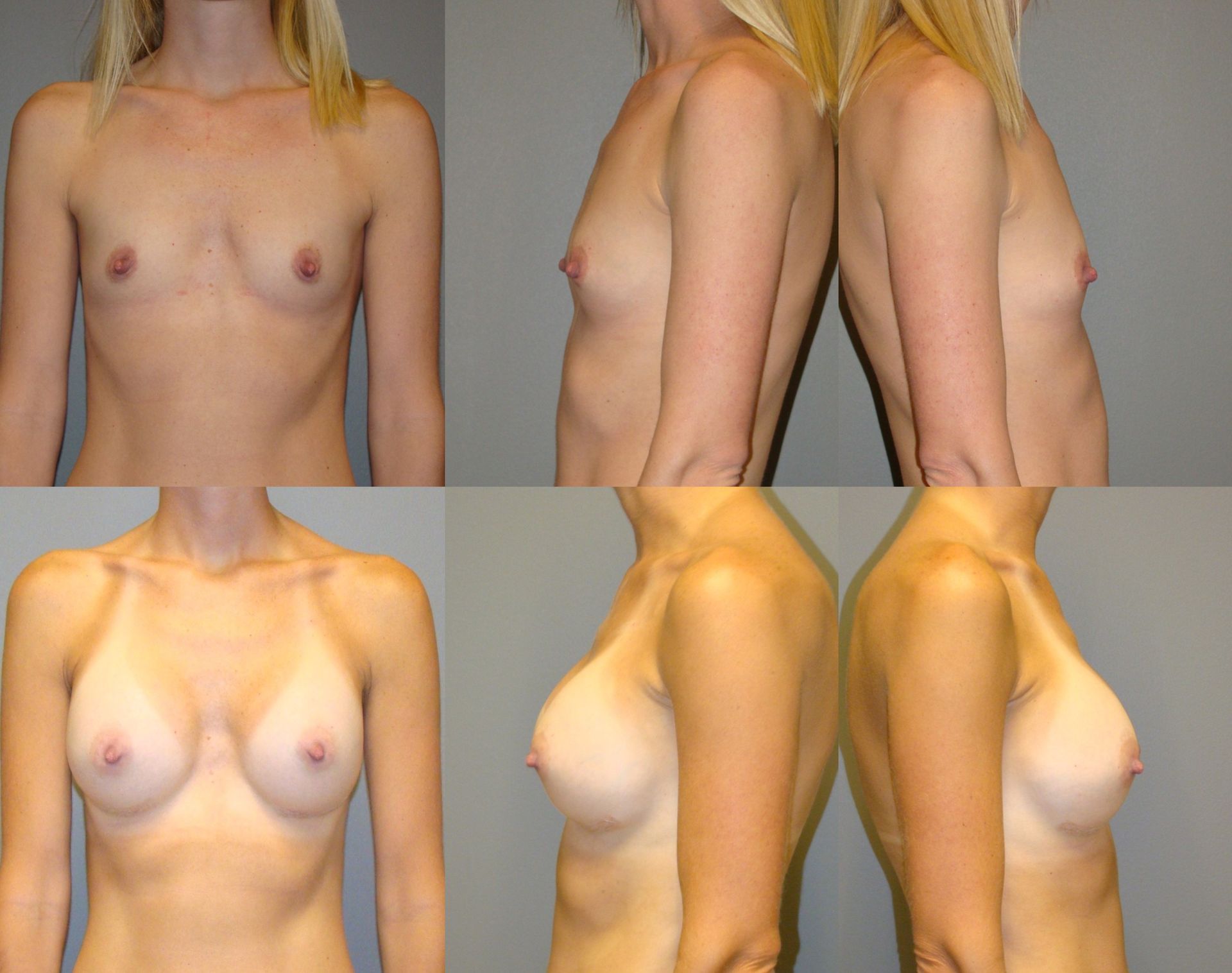 Treatment by Dr. Joseph Greco, Williamson Cosmetic Center, Lake Charles, Louisiana