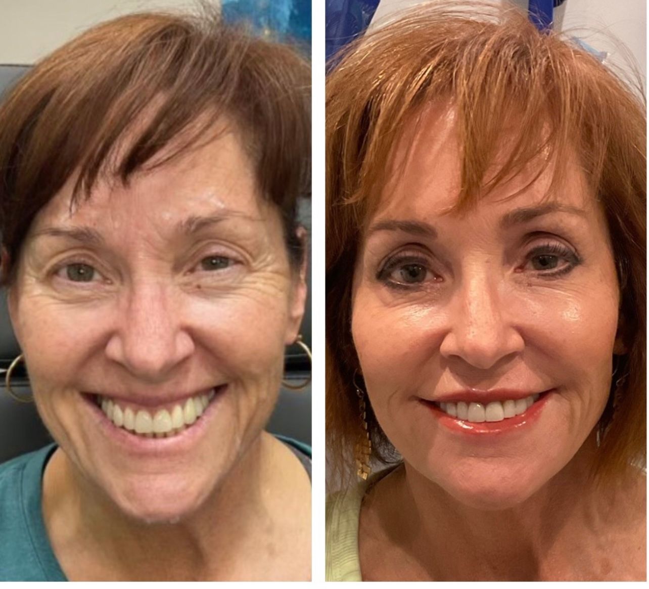 Side-by-side comparison of a person's face. Left shows wrinkles, right shows a smoother appearance.